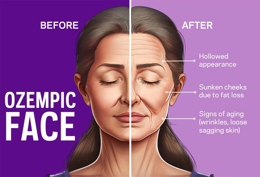 Signs of Ozempic face include sunken temples and cheeks and sagging loose skin